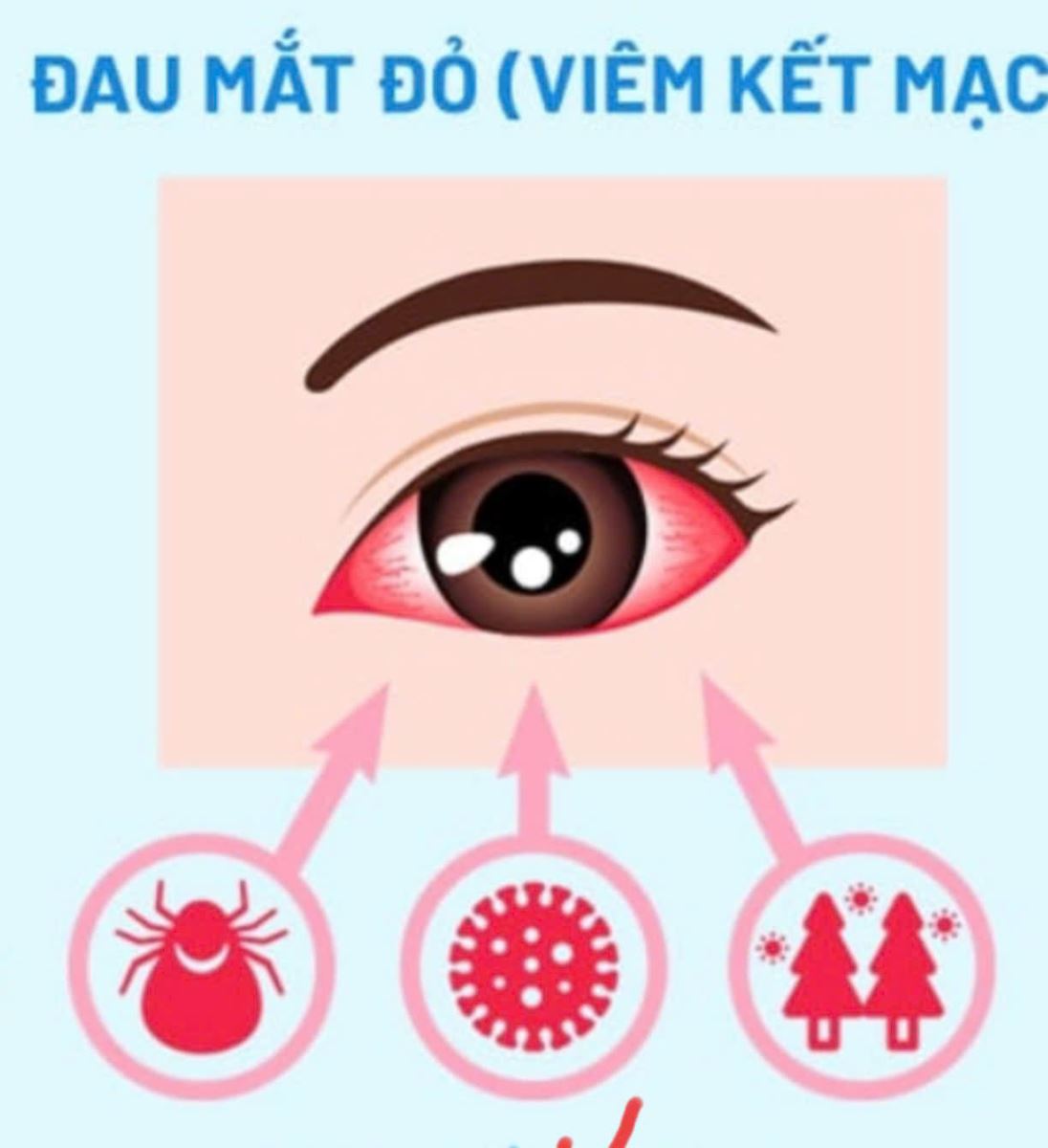 BÀI TUYÊN TRUYỀN PHÒNG BỆNH ĐAU MẮT ĐỎ